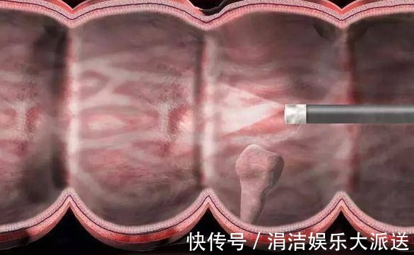 管状腺瘤|两种息肉一定要及时切除,拖五年以上很可能变成恶性肿瘤