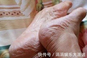 脚后跟|脚后跟的皮肤出现了干裂,不只是皮肤的问题,早知早受益