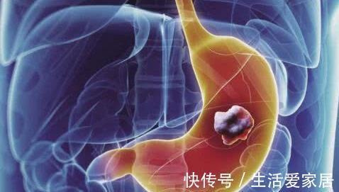 腋窝|胃癌刚发生时,腋窝最先有“异常”,可惜多数人视而不见