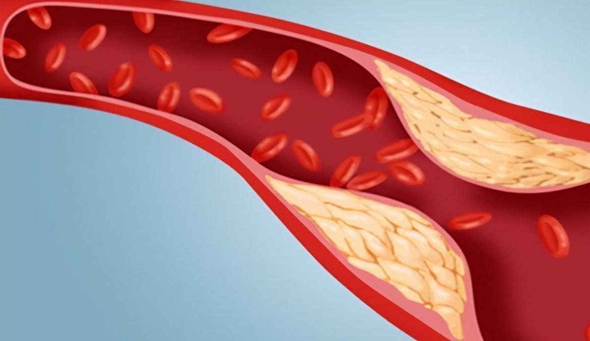 血脂异常|瘦子也会得高血脂？降低血脂遵守“四低一高”原则很重要
