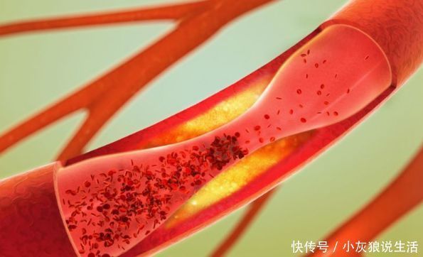 预防脑梗,坚持做好3件小事,软化血管,堪比“溶栓药”!