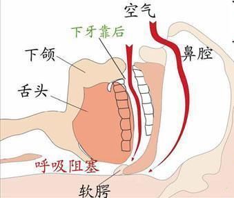 扁桃体肥大|家里有孩子的看过来,宝宝睡觉打呼噜,要引起警惕啦