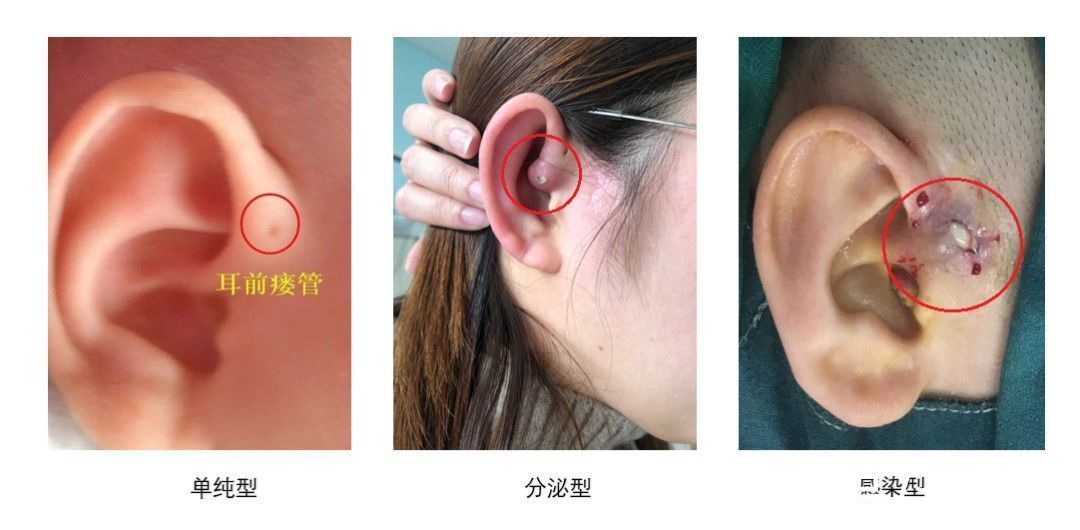先天性耳前瘘管|哈？听说长了它，天生大富大贵还聪明！现实是，10岁女孩因它挨了刀