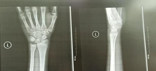 骨骺线|男孩十二岁就变声了,身高一米六五,还能长高吗?