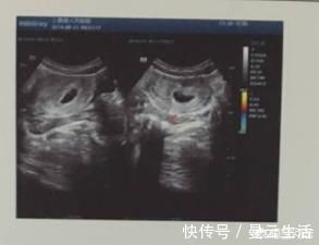 B超检查|为什么怀孕不到3个月,医生还让我做B超检查,有什么意义?