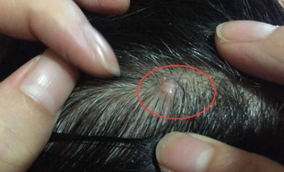  内分泌|头皮上总有“痘痘”，抠破流血伴随疼痛？暴露3大问题一定要重视