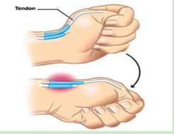 桡骨茎突狭窄性腱鞘炎|“妈妈手”是怎么形成的？它可不是妈妈的专利