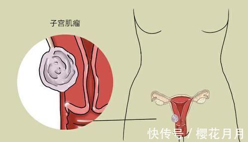 医生|子宫里面有肌瘤的人,不能喝豆浆吗?医生:该戒掉的是这两物