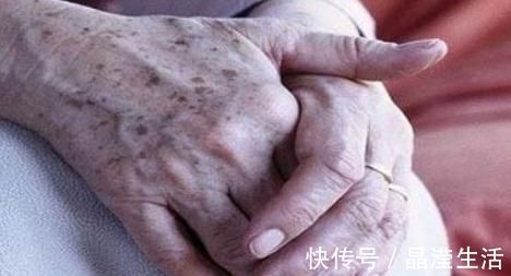 老年斑|为什么年纪大了容易有“老年斑”?专家说:常吃2物,可及时避免