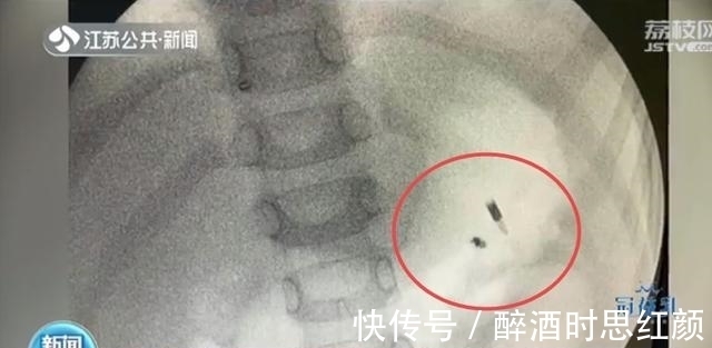 钉子|5岁男孩误吞下铁钉 一个月后,被胃酸腐蚀变粉碎