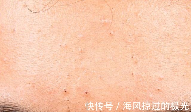 泡沫|看到黑头就想挤担心越挤越多!网上3种方法才损伤皮肤,要避开
