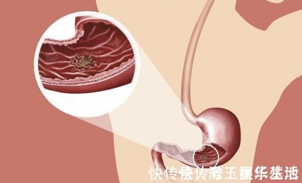 胃癌|胃癌早期不痒不疼，饭后若有以下4个“异常”，多半需要就医了