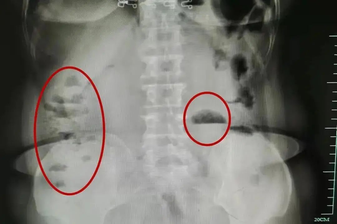 肠梗阻|一口气两个脆柿下肚，杭州阿姨仿佛被人使劲“拧肠子”！这几点要注意！