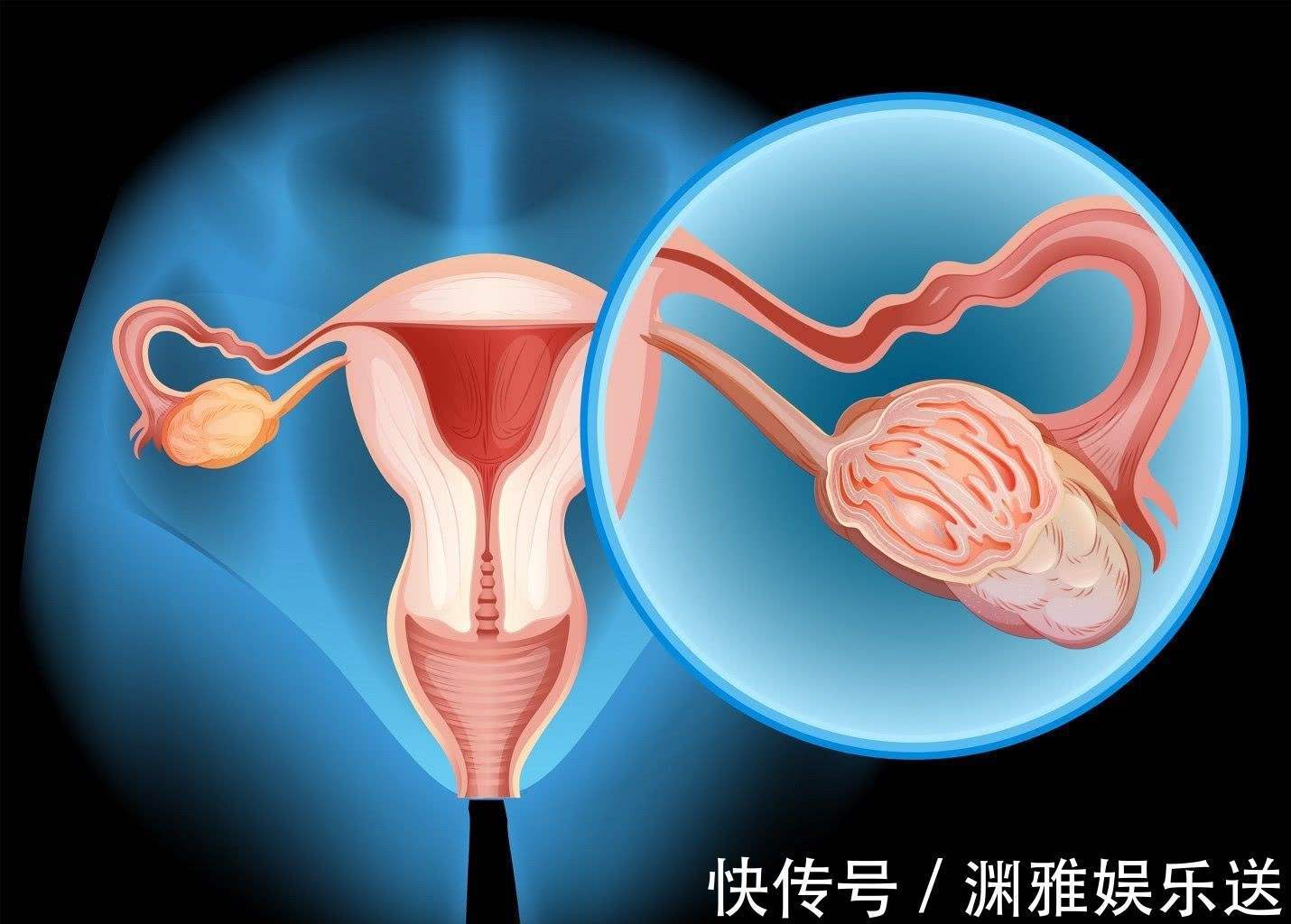 出血|卵巢癌一般有哪些表现6个主要特征要记好