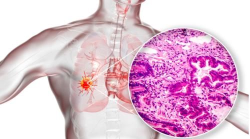 癌变率|多发肺结节癌变率有多高？医生提醒：一定要注意这3点