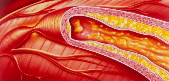 颈动脉|近2亿人有颈动脉斑块,60岁以上几乎全有,2个方法让它“消失”