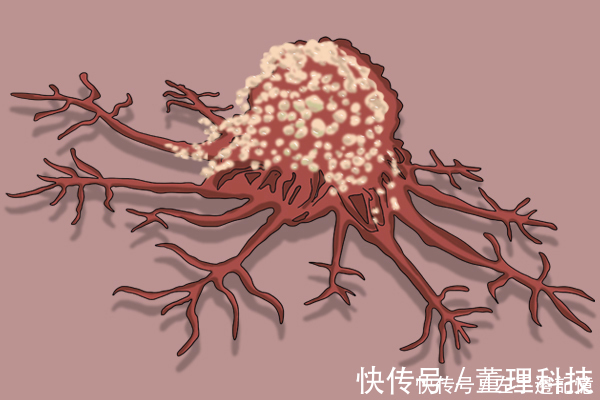 斑块|医生提醒大家,得了癌症,皮肤是会给出信号的,4点异常较为明显