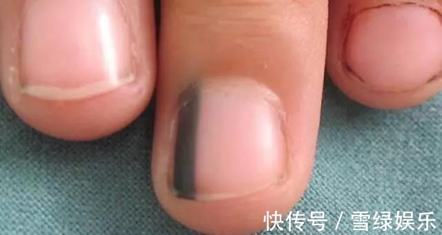 癌症|指甲上有黑线，可能是最恶的癌症，医生教你怎么办
