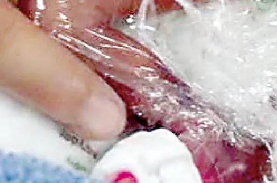 月月|奇迹！出生时体重才一斤多！“迷你宝宝”闯过重重难关