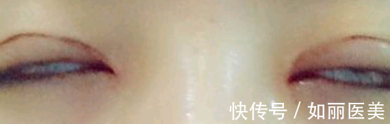 手术 什么样的双眼皮手术意味着失败了?术后多久才能进行二次修复?看完这篇,你就知道啦~