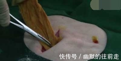 儿子|剖腹产生下儿子后,腹部剧痛难忍,医生再次打开肚子,吓得傻了眼