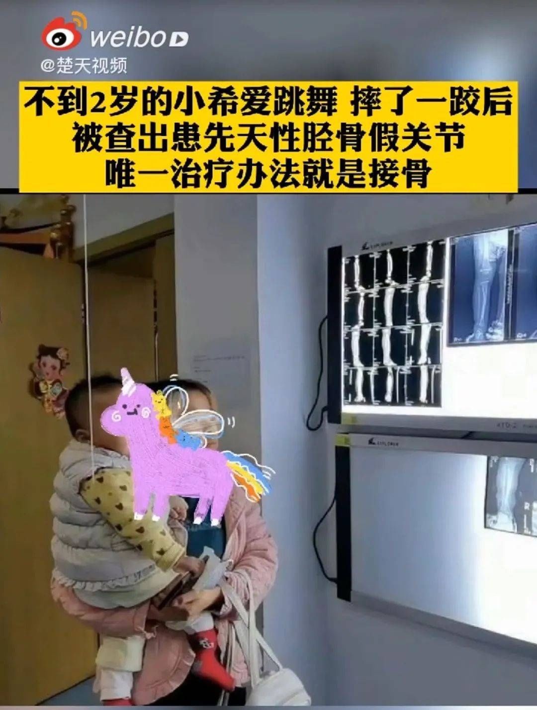 忍痛|“比生孩子还痛！”90后妈妈忍痛取骨救女：只要她能站起来，我什么都愿意！