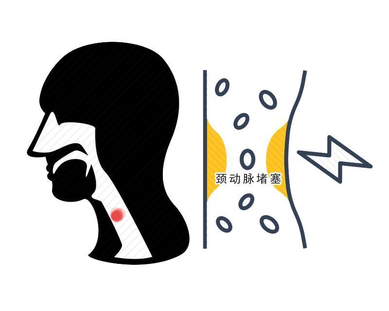 动脉|血管堵没堵,摸一摸5个部位就知道!占两个,要警惕血栓