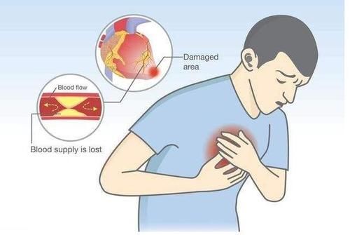  发病|心肌梗塞发病前，5个信号会浮出水面，及时发现还有救！