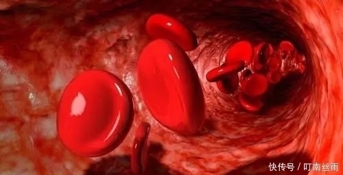 溶解|血管不堵的人，身体会有5个表现，占2个以上，恭喜你血管还不错