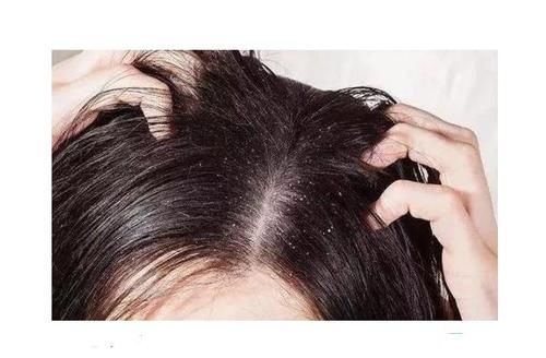  导致头皮|头皮上总能抠出白色的泥？还有痘痘和小硬块？医生告诉你答案！