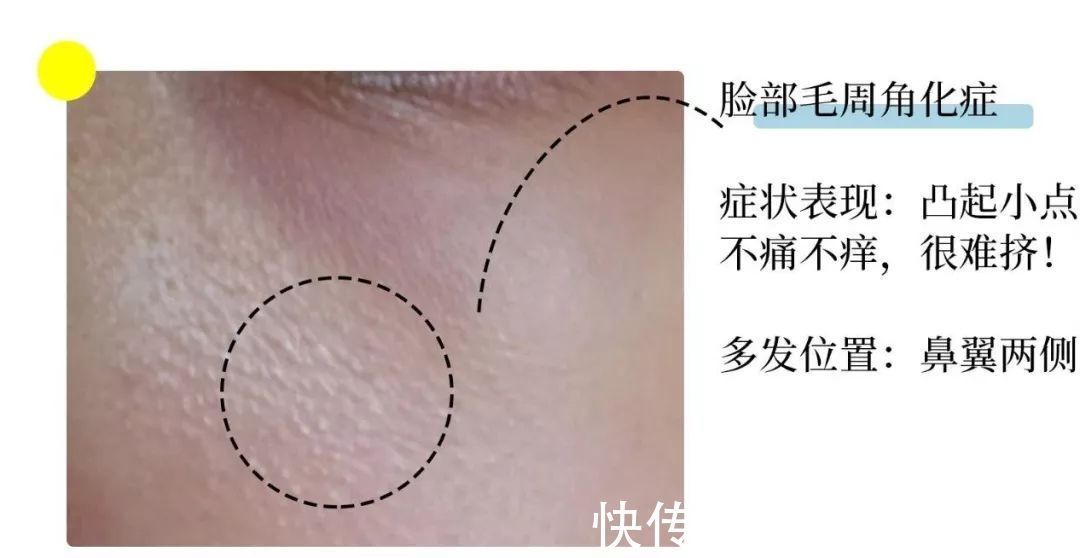 毛周角化|眼睛周围有脂肪粒怎么办?