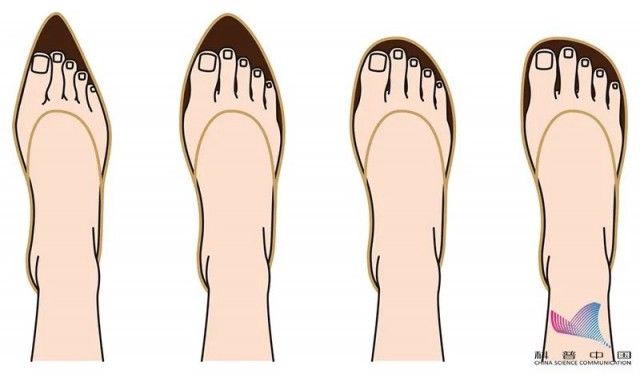 高跟鞋|女子爱穿尖头鞋竟患上这种“瘤”！不同脚型该怎么选鞋？今天说清楚了