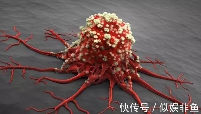 肿瘤|专家:6点抗癌忠告,若不想癌症近身,不妨记一下,或许受益终身