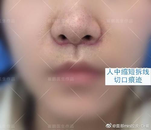 人中缩短术后护理怎么做恢复快？