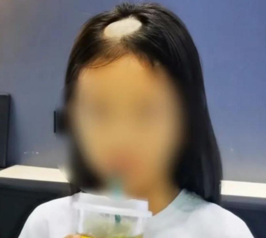 小女孩|6岁女孩突然“秃头”,奶奶以为是鬼剃头,医生怒斥无知