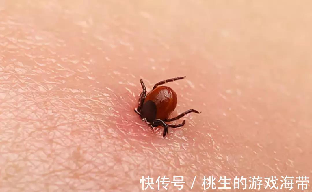 医生|夏天蜱虫多,孩子被咬后别硬拔,宝妈学会三个急救法,医生都夸好