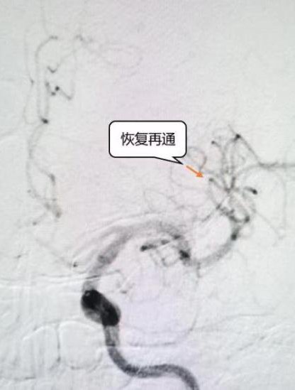 缺血性脑卒中|85岁突发急性脑梗,静脉溶栓联合血管内介入治疗挽救生命
