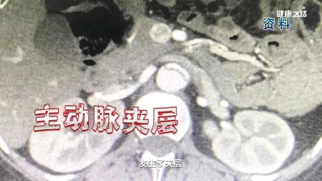 医生|开车太颠导致脑梗?医生提醒:年轻人也要关注!