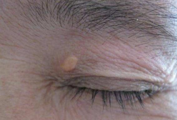 怪状|血脂高的人,头上会有5种“怪状”,学会3招,不怕脑梗找上门