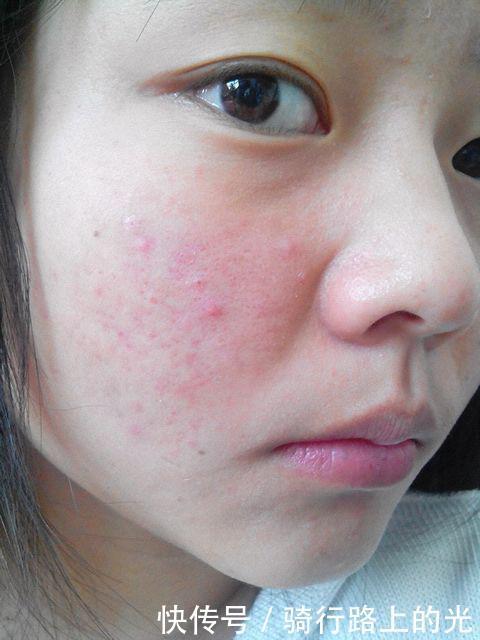 断货王|那些“断货王护肤品”太坑了，粉水、黄油均上榜，用完长痘还过敏