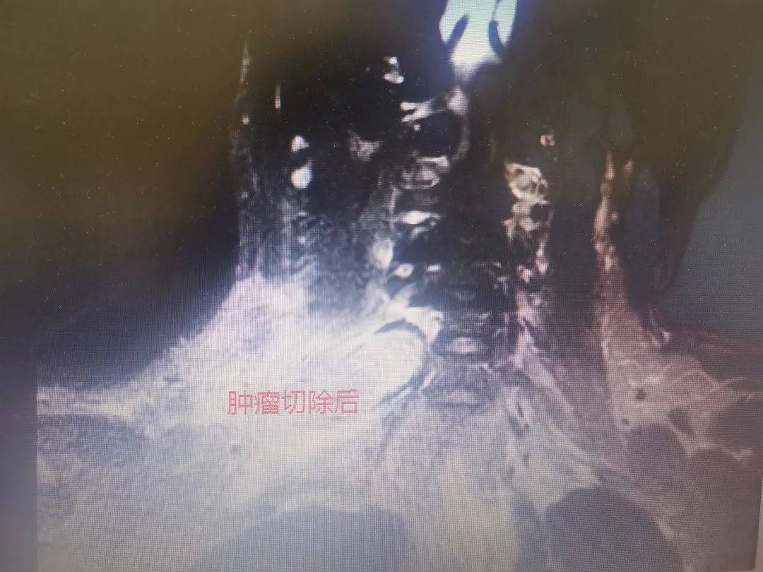 多学科|38岁男子脖子上长鹅蛋大肿块，医生多学科联合切除巨大神经鞘瘤