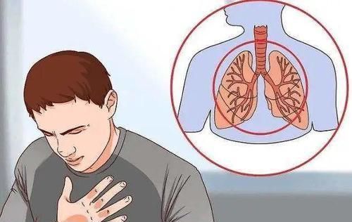 肺癌为什么会肩疼?肺癌引起的咳嗽有何特点