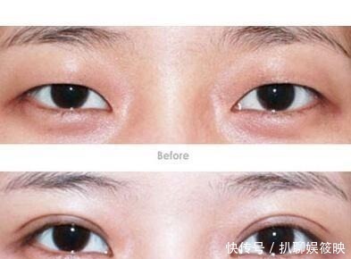手术|做过双眼皮手术的年轻人,老了以后眼睛会怎么样?看来是这个道理