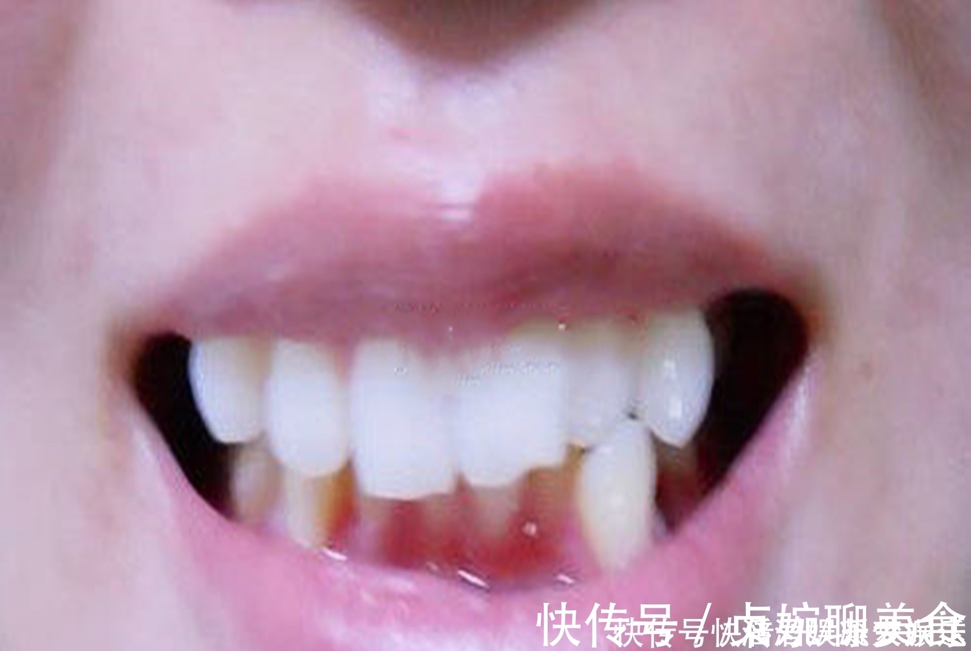 父母|好不容易等到宝宝换牙期,新牙却长歪了医生家长无知惹得锅