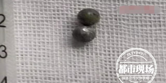 手术治疗|男孩呕吐、高烧送进医院!医生:肚子里“藏”了玩具