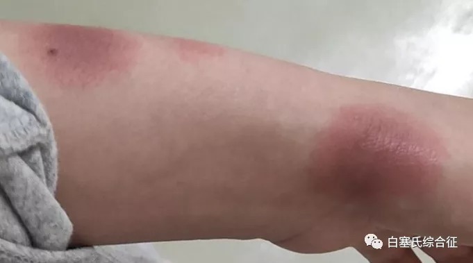 中医|自古中医就对白塞氏病有研究