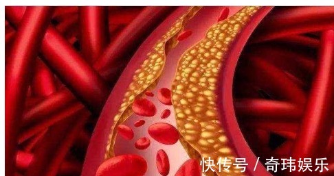 高密度脂蛋白|医生一步一步教您看血脂化验单,并不是有箭头就不正常!