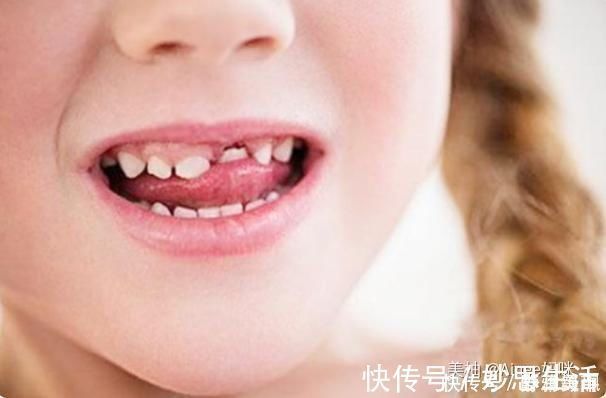 人的一生|孩子乳牙整齐漂亮,换牙后却越来越“歪”可能是这几点没做好