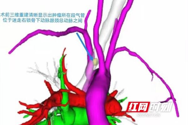 肿瘤|长沙8岁女孩咳嗽一个月不见好 竟是气管内长了肿瘤