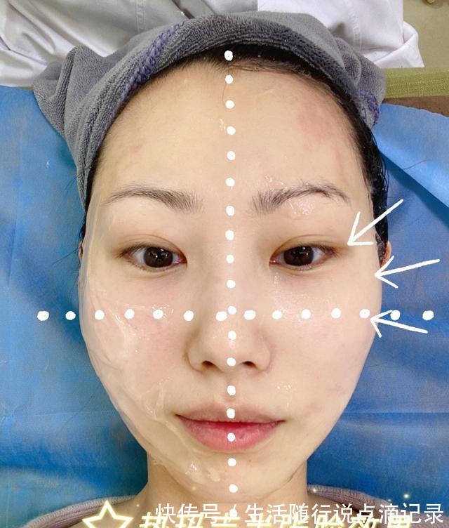 面部 对抗地心引力一直在路上丨面部热玛吉初体验!